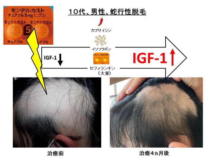 円形脱毛症　病院